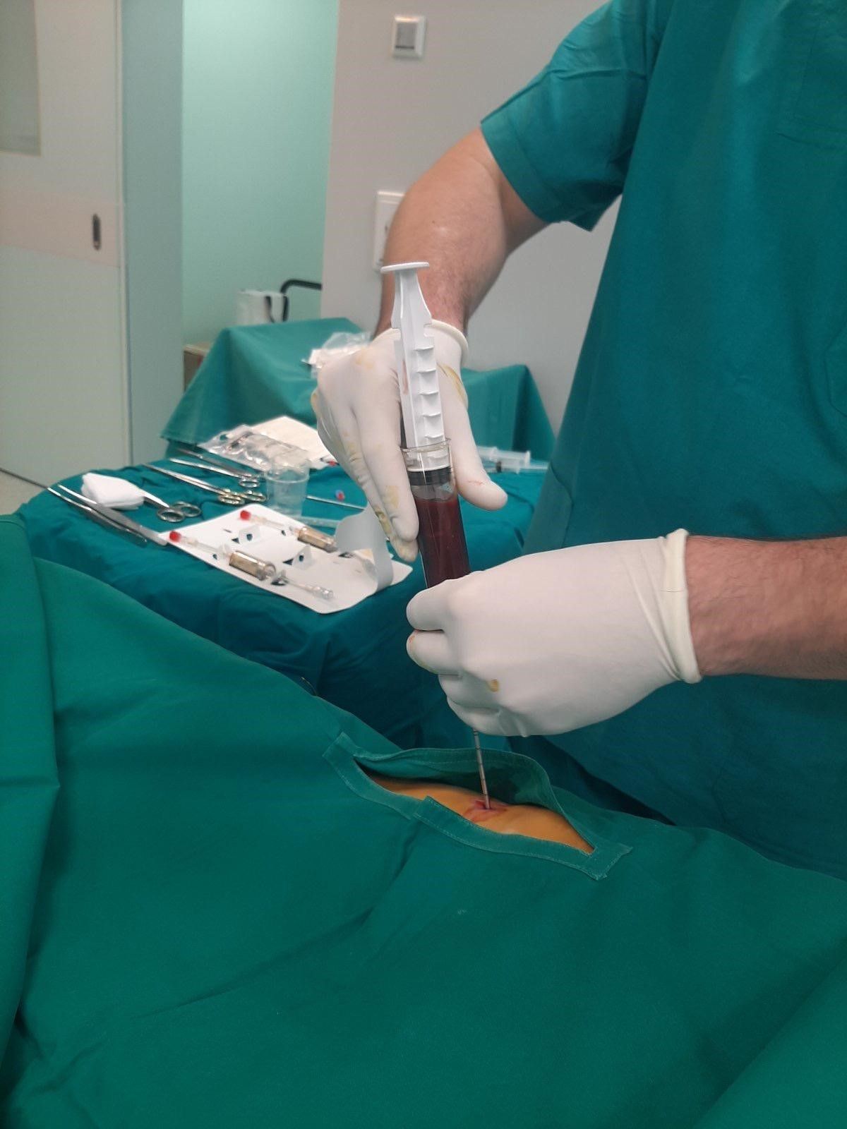 Terapija matičnim stanicama iz koštane srži (BMAC)